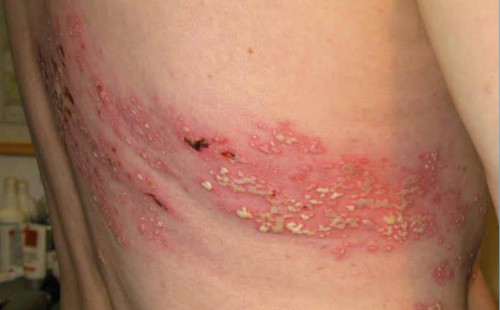 Herpes Zoster(Zona)