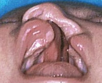Beemer-Langer sendromu (short-rib thoracic dysplasia 12)