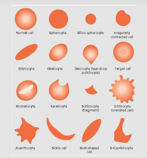 Farklı hastalıklarda görülen eritrosit şekilleri