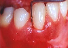 Jüvenil periodontitis sendromu