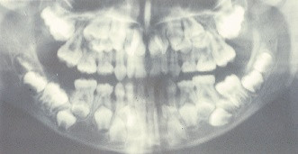 Süpernümerer diş - Artı diş - Hiperdonti