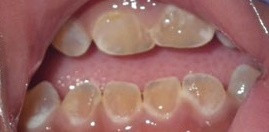Dentin defektleri