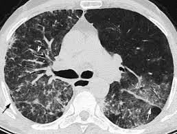 koronavirüsün neden olduğu pnömoninin akciğerde oluşturduğu hasarın tomografi görüntüsü